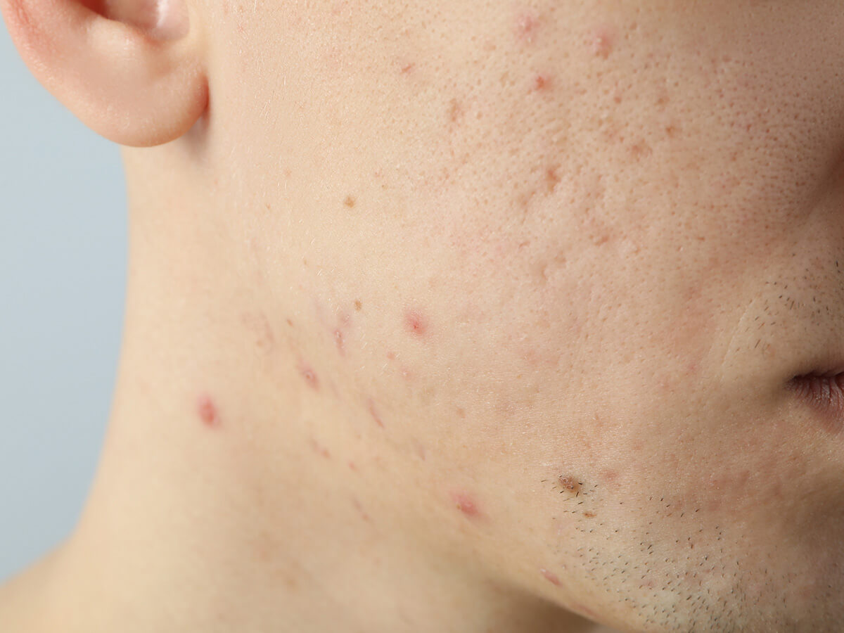 Acne