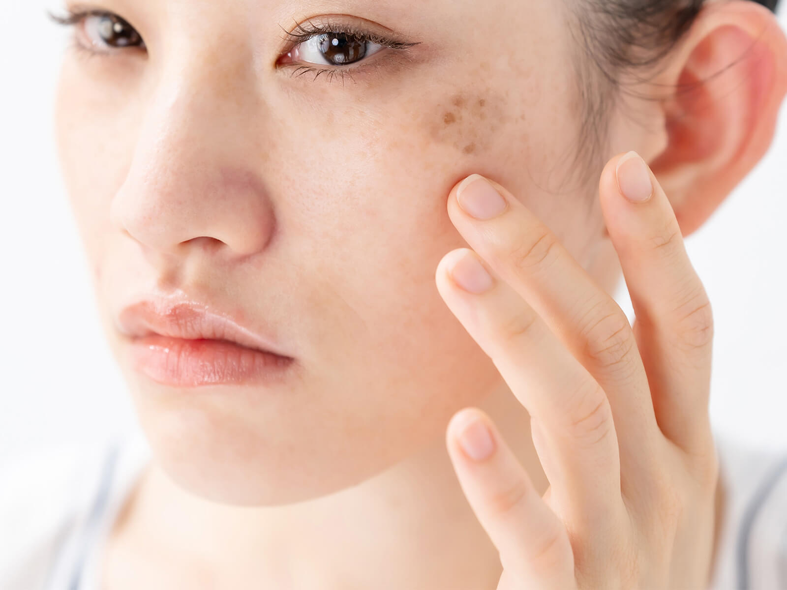 Freckles, Age Spots, Dullness