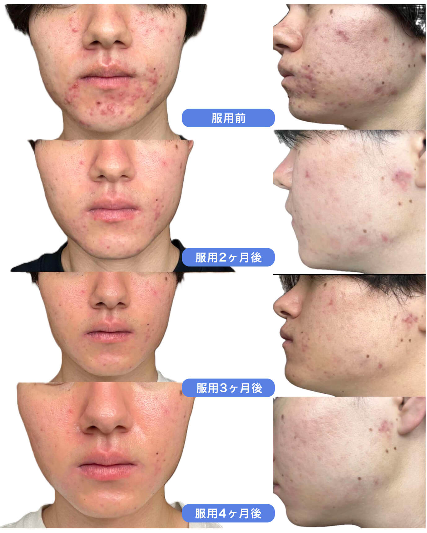 イソトレチノイン