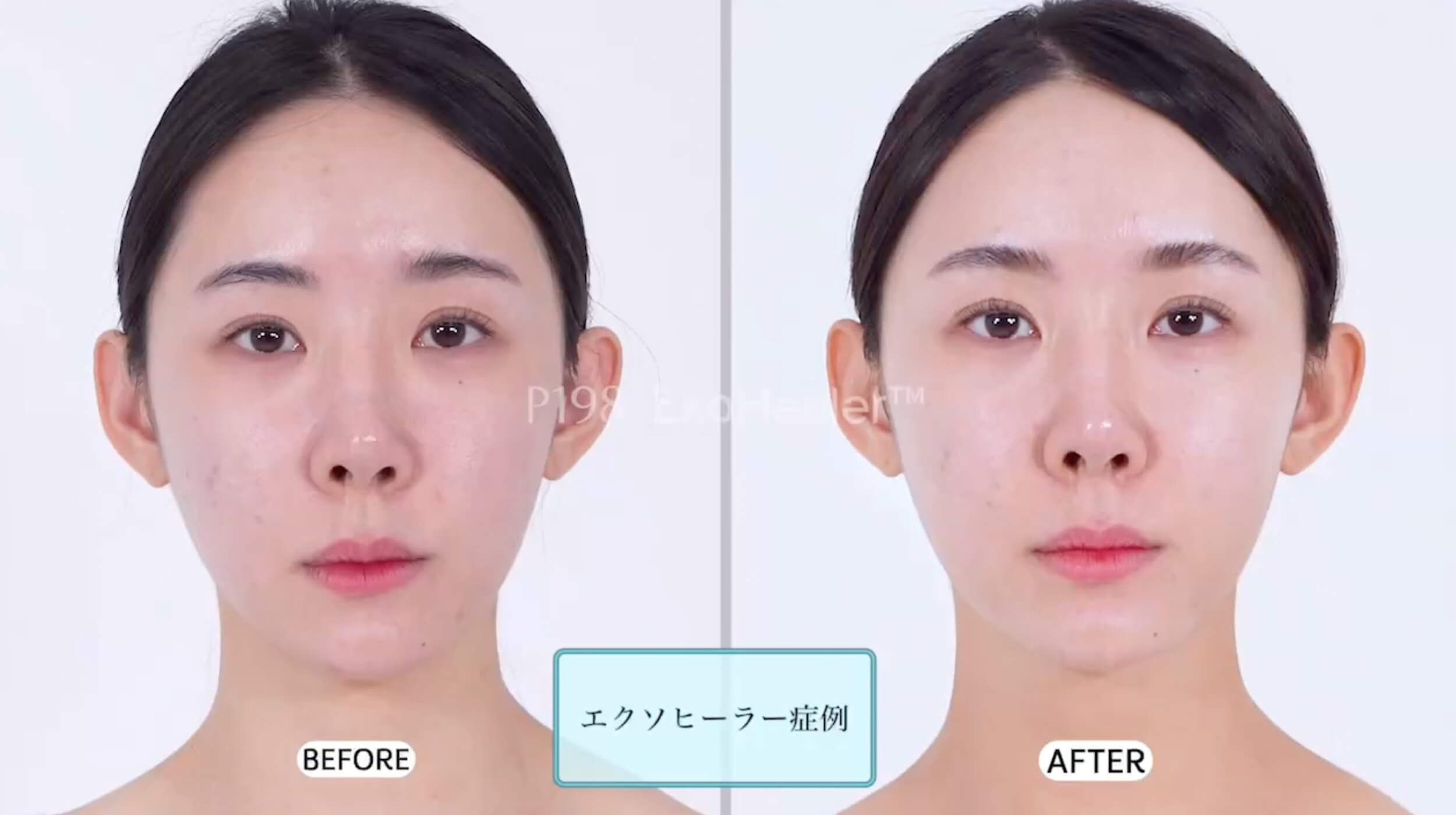 EXOMUNE エクソヒーラー　ファルコア 6本×2 EXOCOSMALL: 専門家のための美容