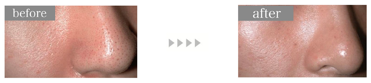 デュアルピール