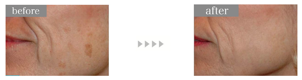 シミ取りレーザー