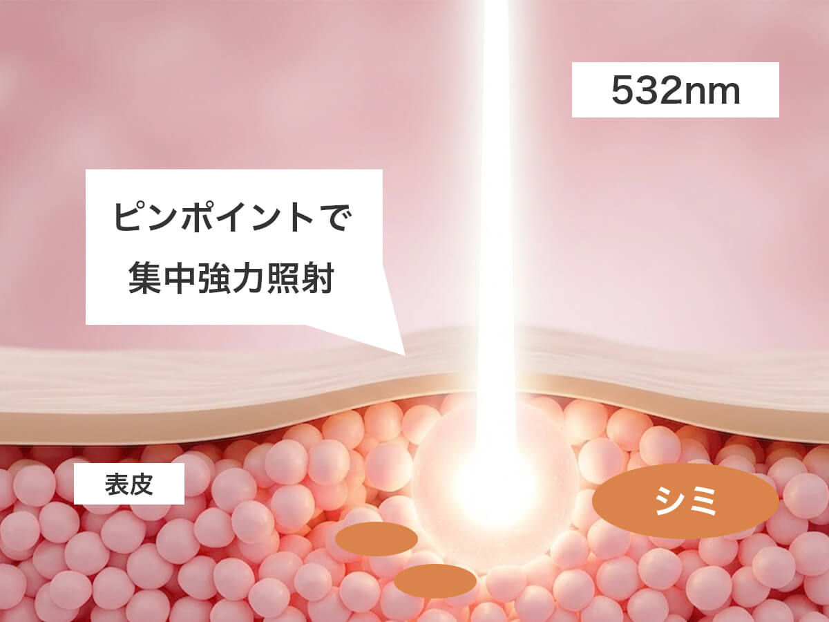 シミ取りレーザー