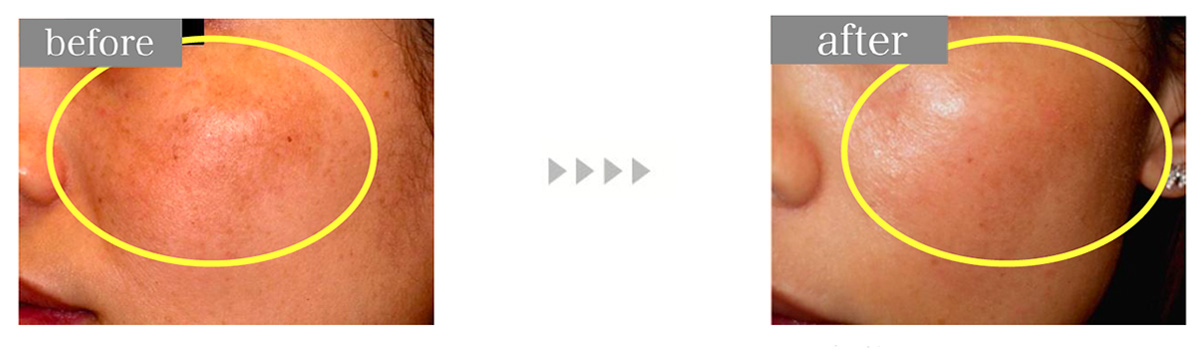 ハリウッドトーニング