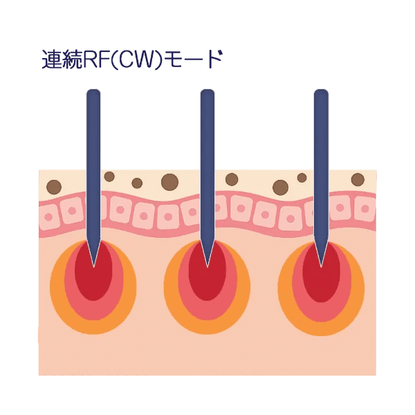 ニードルRF（CW）