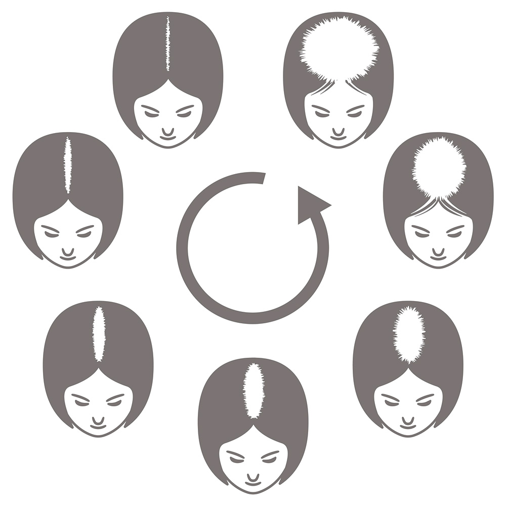 女性薄毛