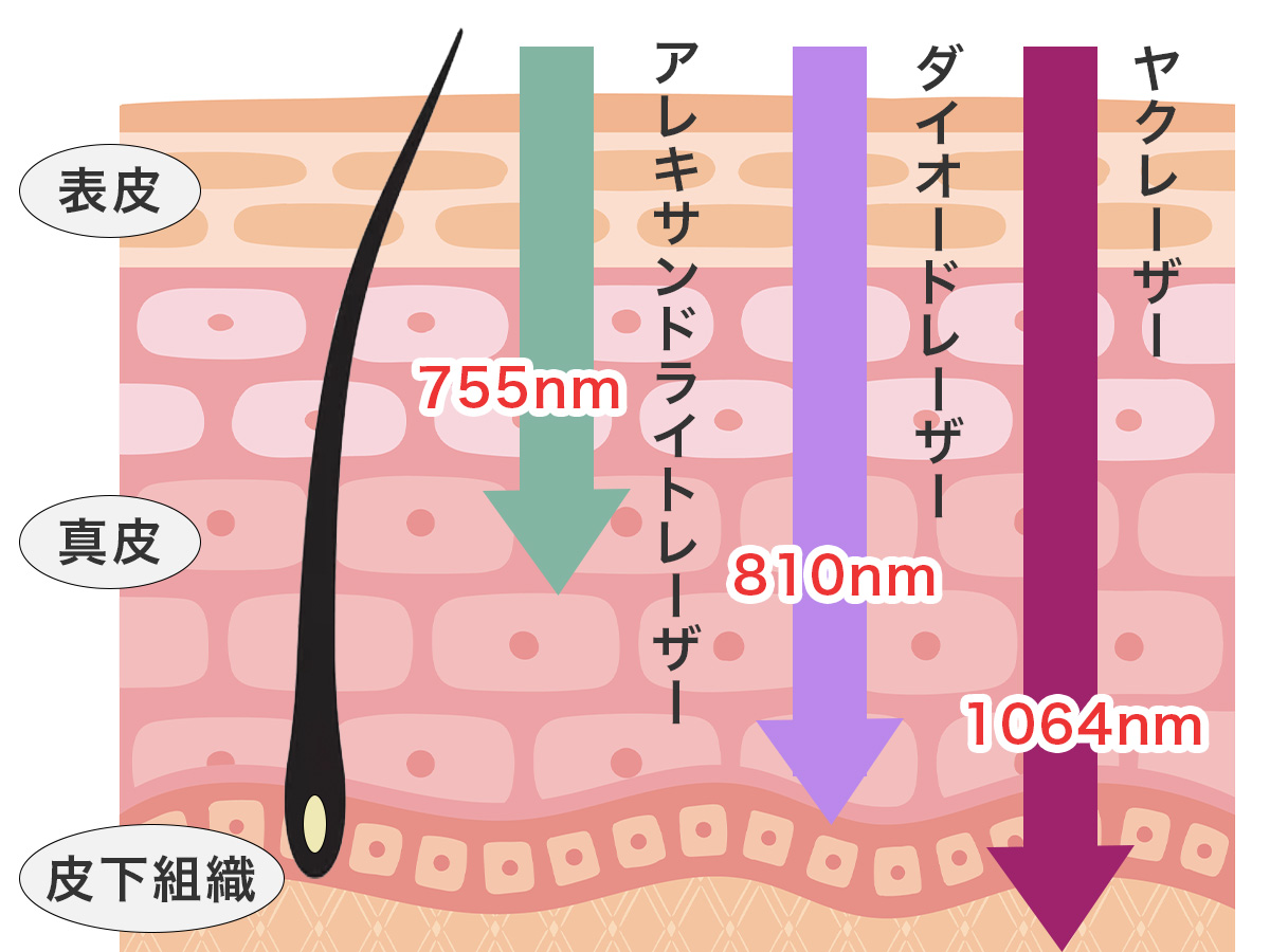 レーザー脱毛