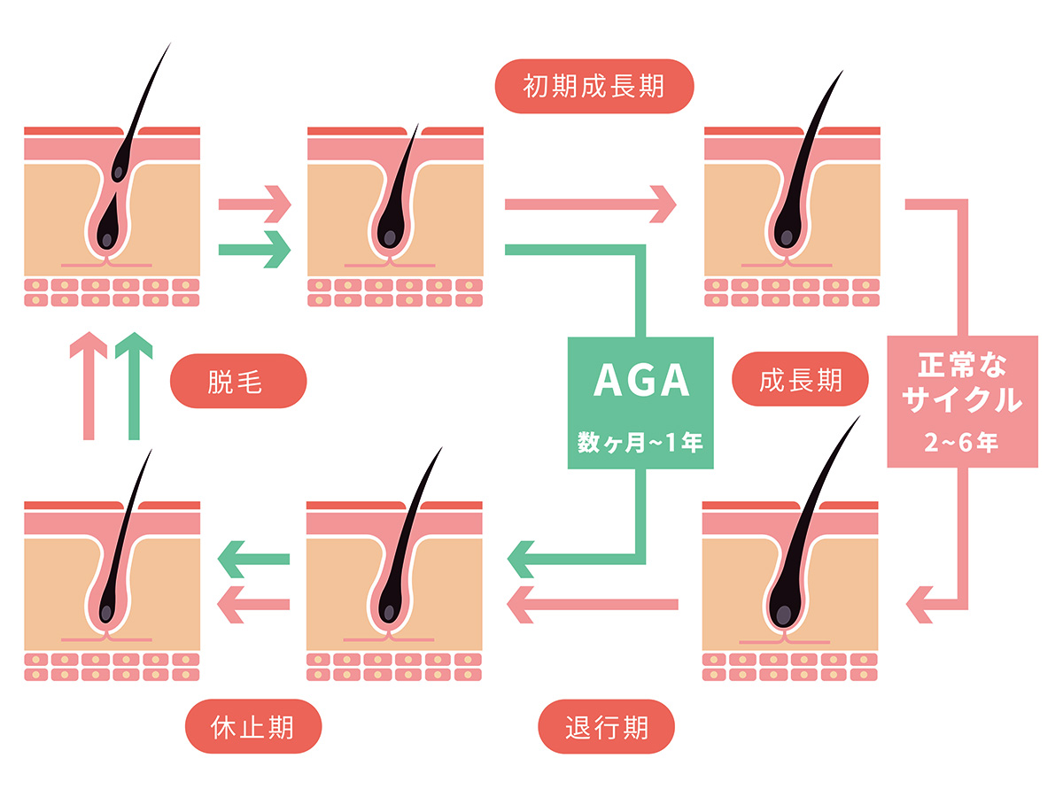 AGA引发的病理变化