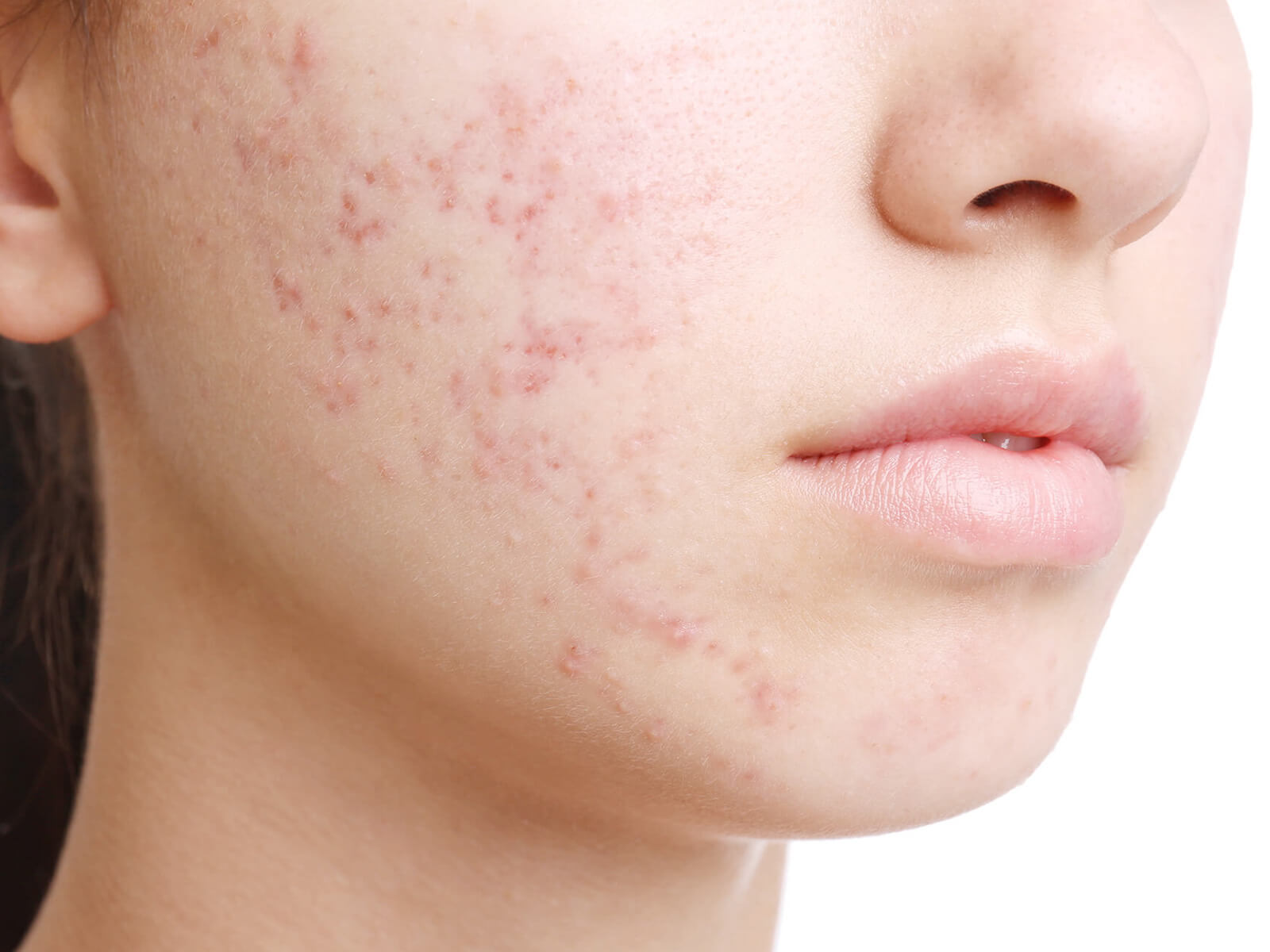 痤疮