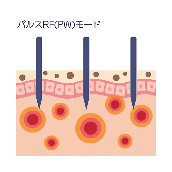 微針RF(PW)